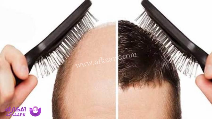 استخدام المشط بعد زراعة الشعر