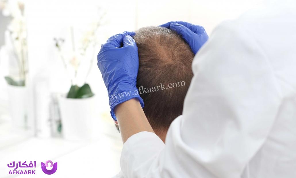 عيوب زراعة الشعر بالاقتطاف