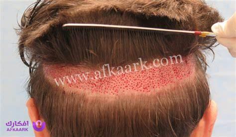 أضرار زراعة الشعر على المدى البعيد