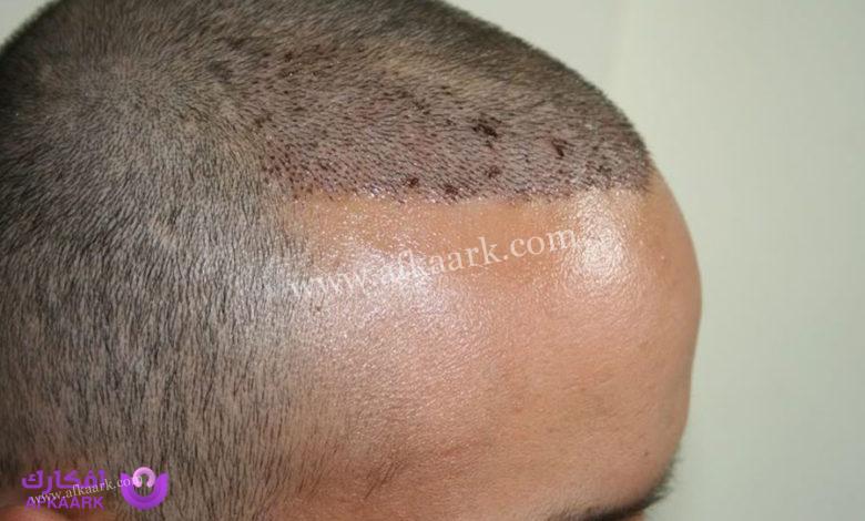 العناية بالمنطقة المانحة بعد زراعة الشعر