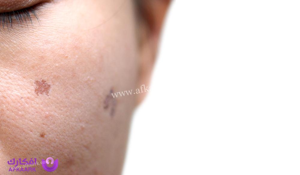 متى تختفي النقاط السوداء بعد الفراكشنال .. المدة الطبيعة المراحل التابعة للعملية 10 متى تختفي النقاط السوداء بعد الفراكشنال .. المدة الطبيعة المراحل التابعة للعملية